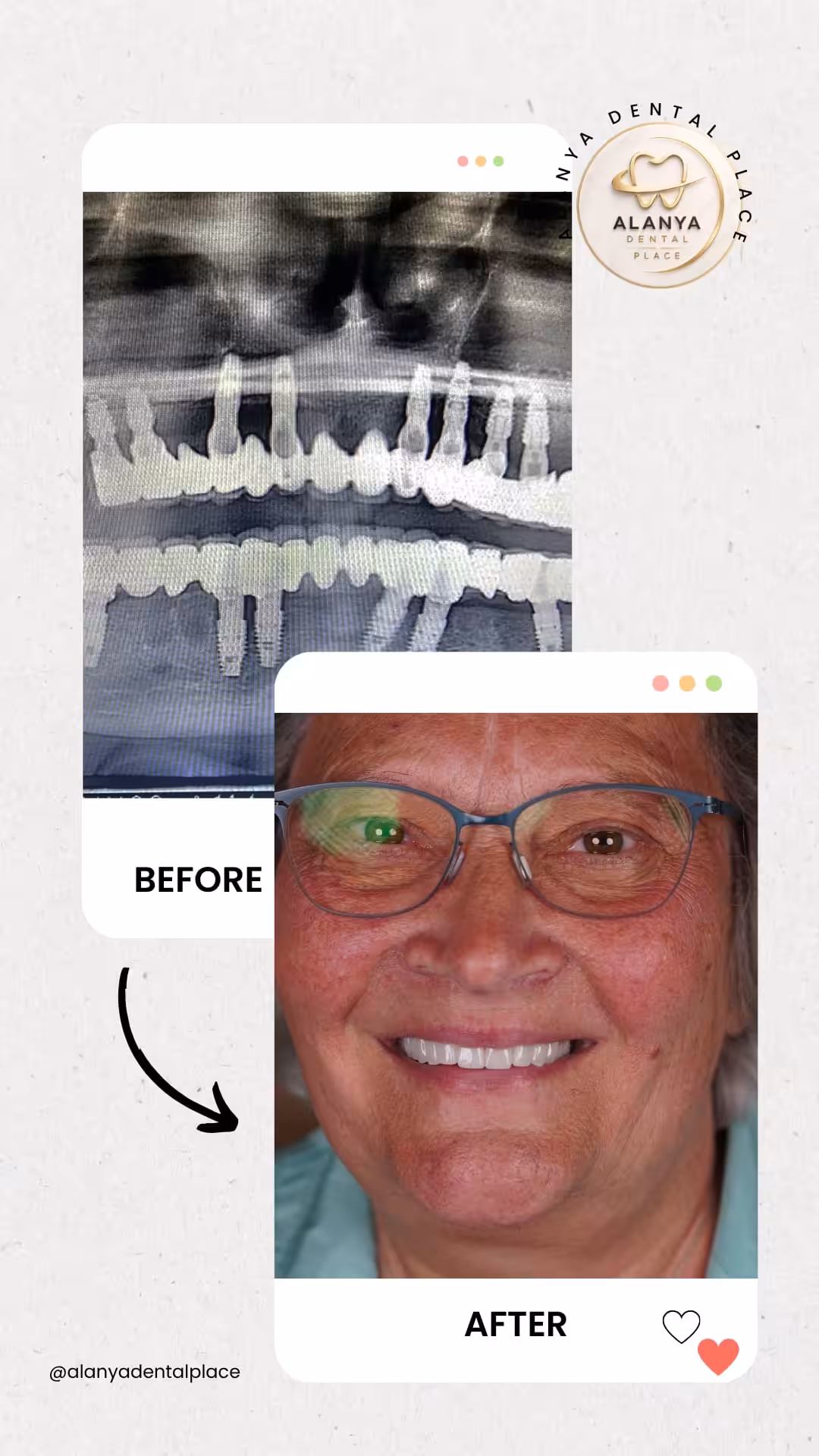 Zahnimplantate 15 before after 55