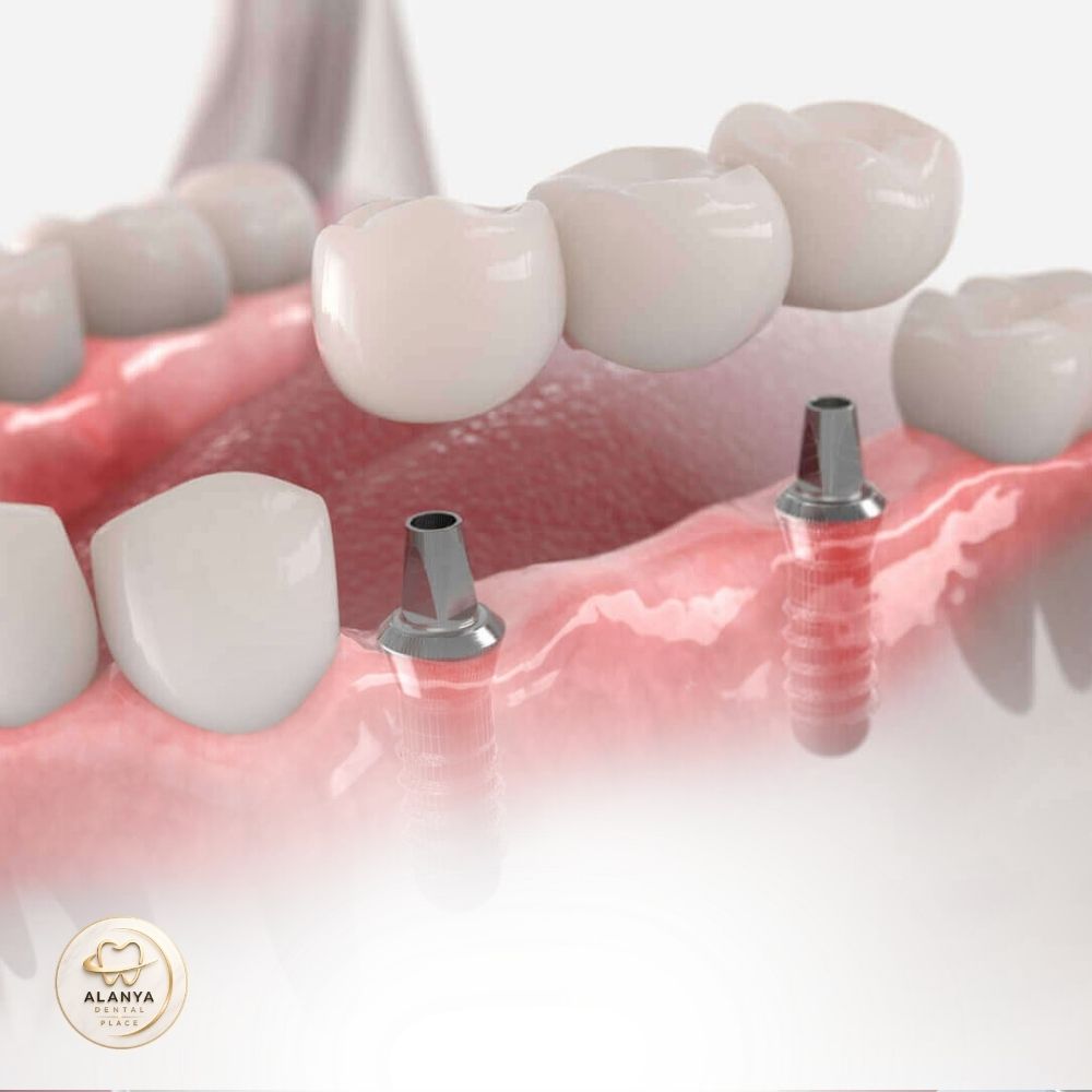 Dental Implants 35 Image link