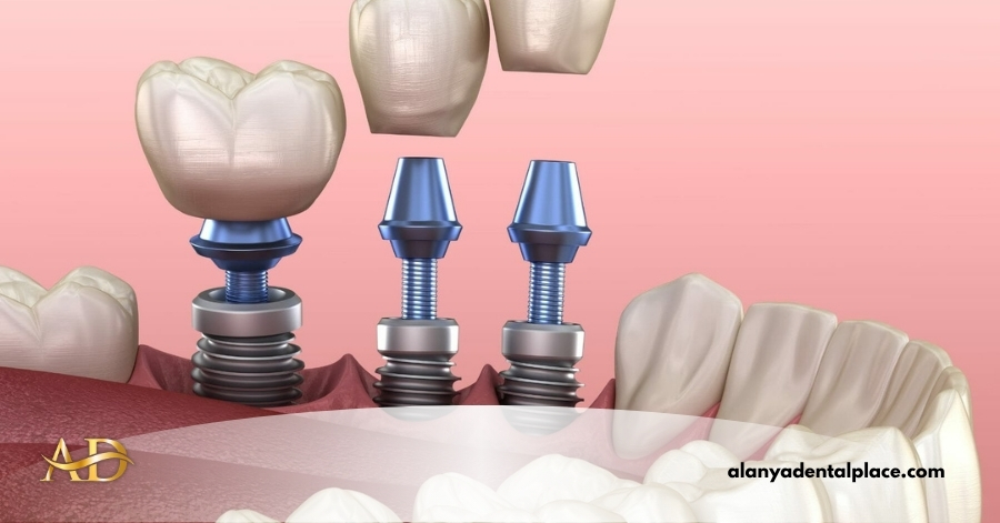 Dental Implants 1 Image link